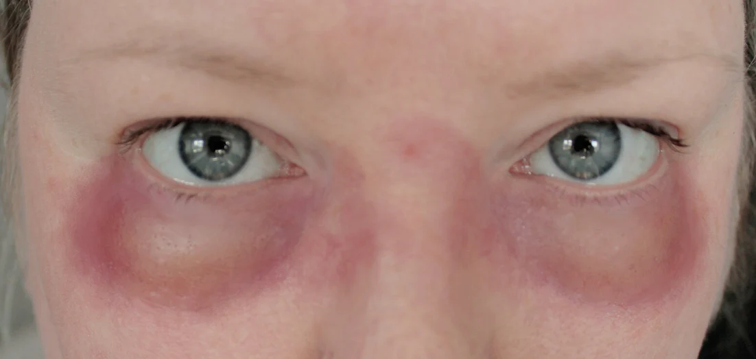 Jess FX Bondo Moulds - under eye swellings