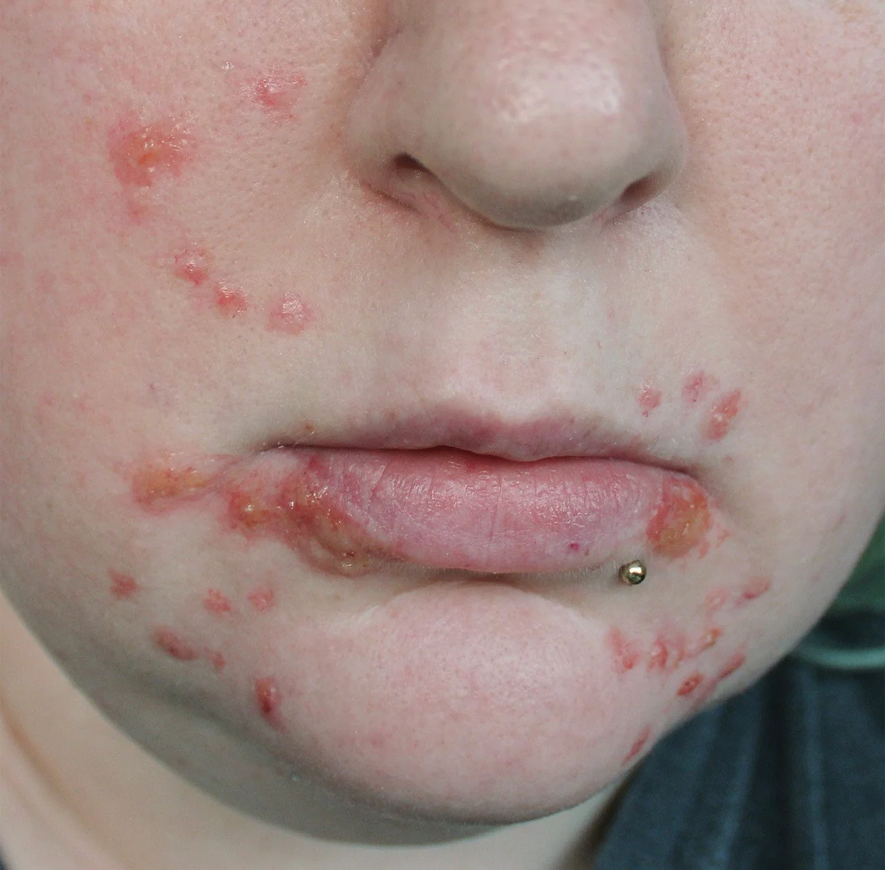 Jess FX Bondo Moulds - Acne