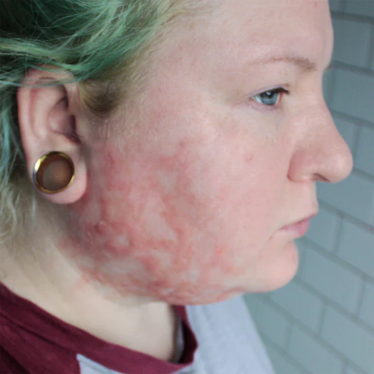 Jess FX Prosthetic Appliances - Burn Scars Set