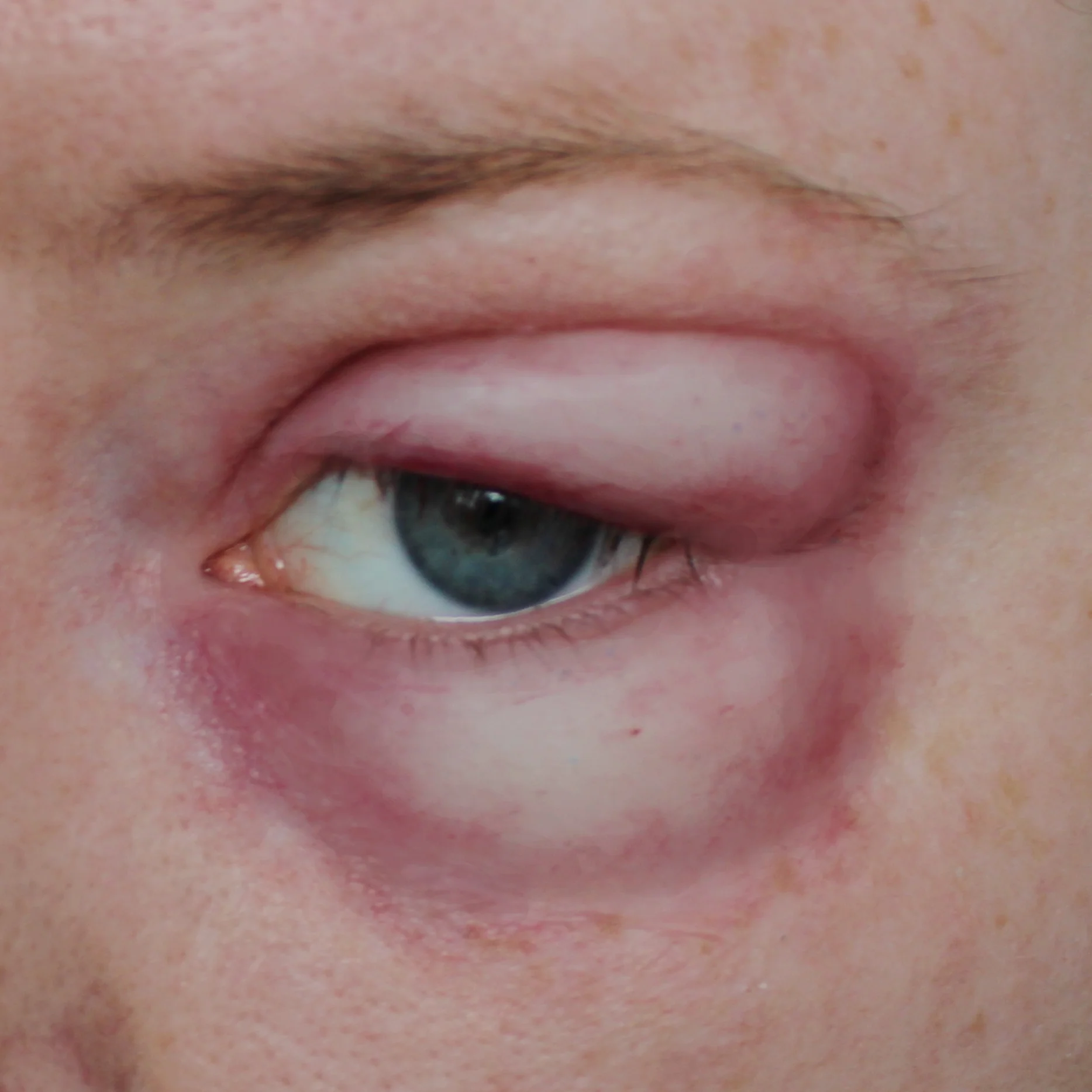 Jess FX Prosthetic Appliances - Swollen Eyes