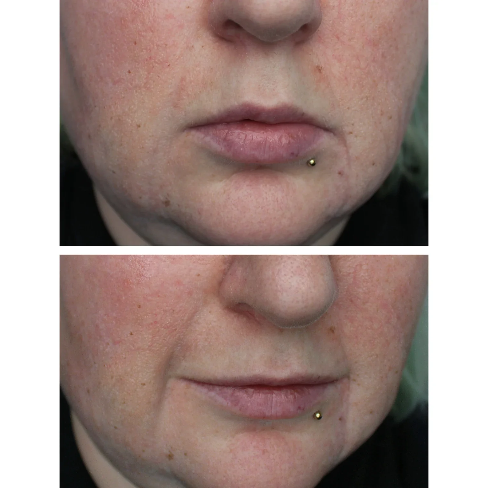 Jess FX Prosthetic Appliances - Nasolabial Folds