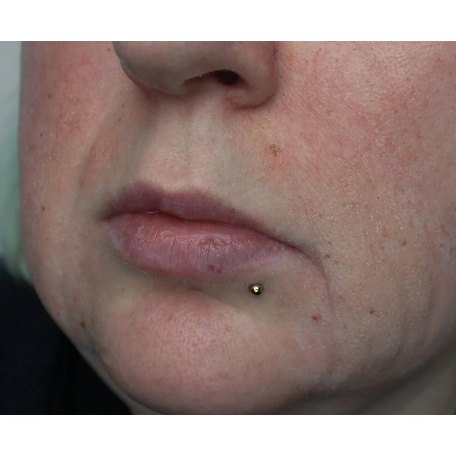 Jess FX Prosthetic Appliances - Nasolabial Folds - Image 3