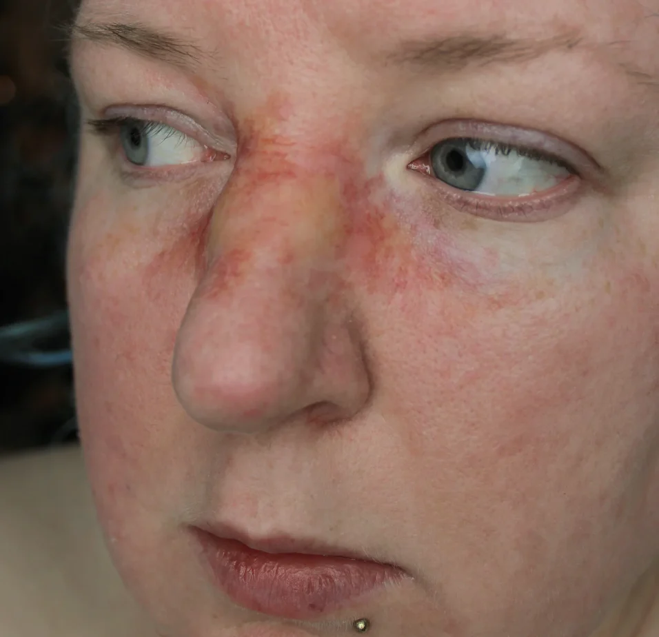 Jess FX Prosthetic Appliances - Broken Nose 1