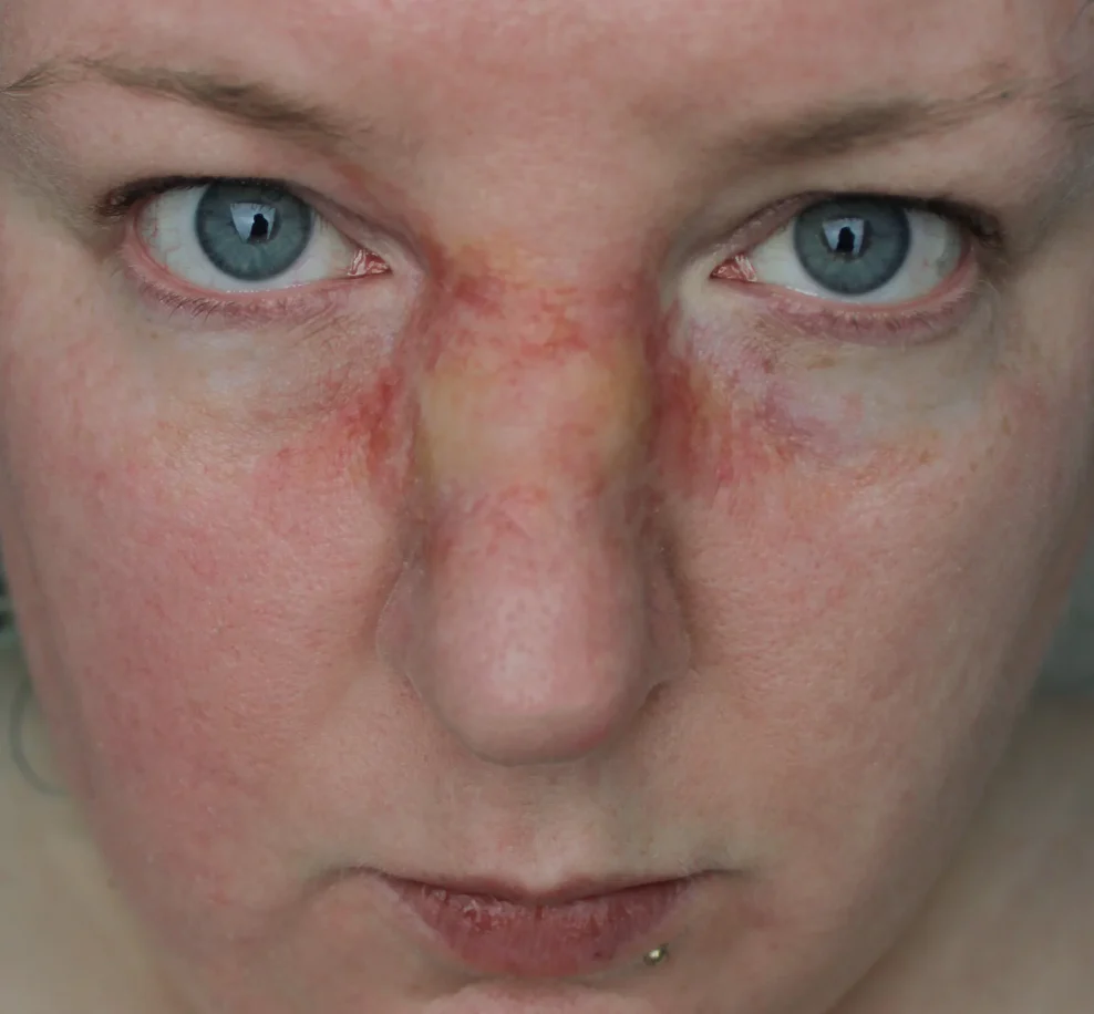 Jess FX Prosthetic Appliances - Broken Nose 1 - Image 2