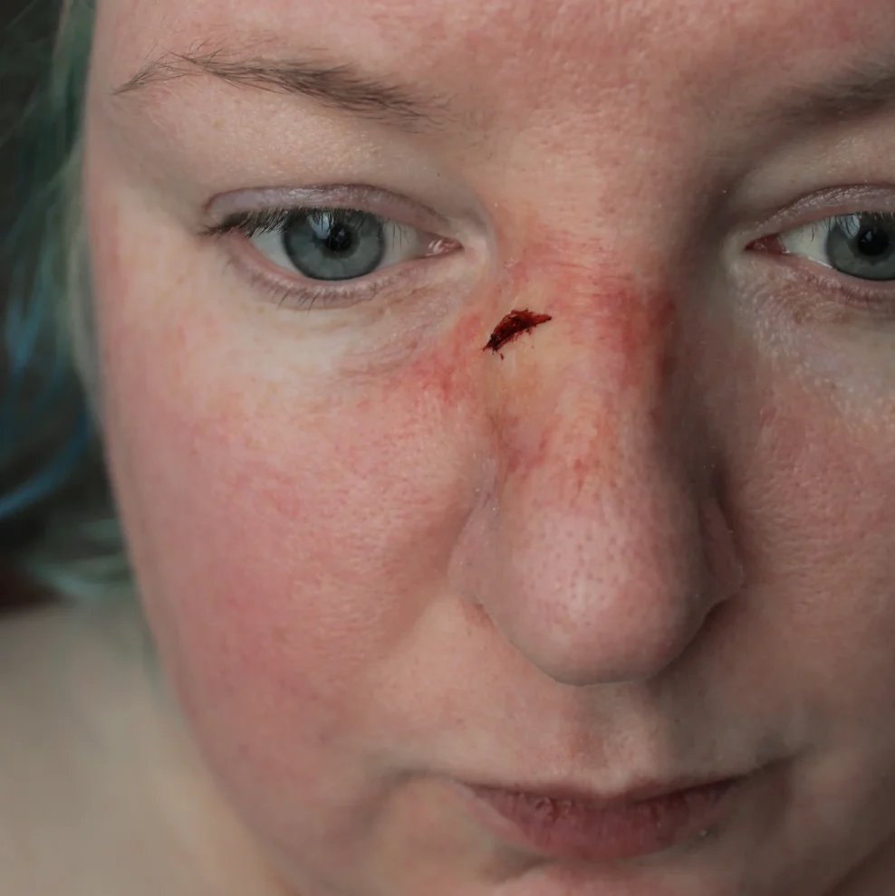 Jess FX Prosthetic Appliances - Broken Nose 2