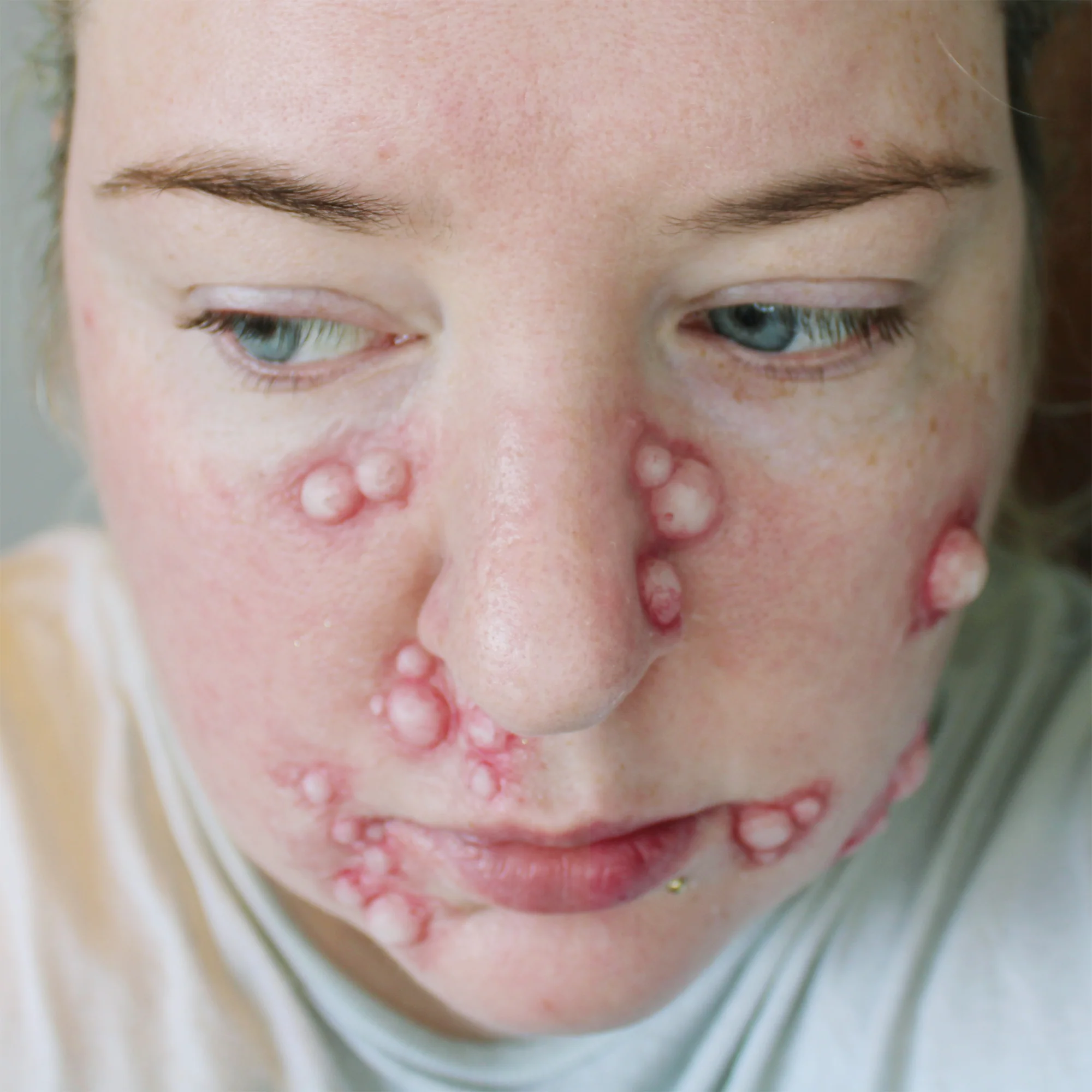 Jess FX Prosthetic Appliances - Small Boils Set