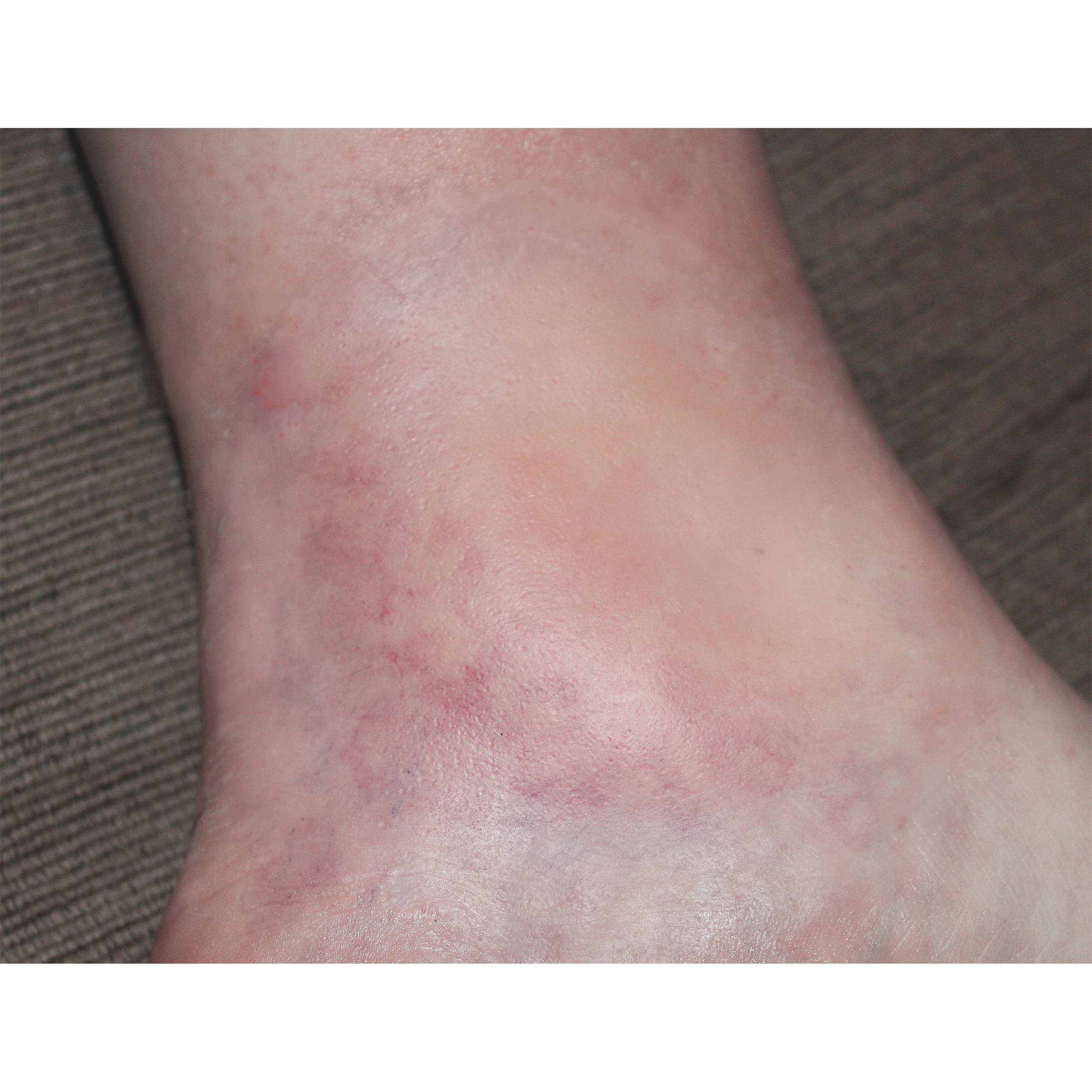 Jess FX Prosthetic Appliances - Subtle Swelling