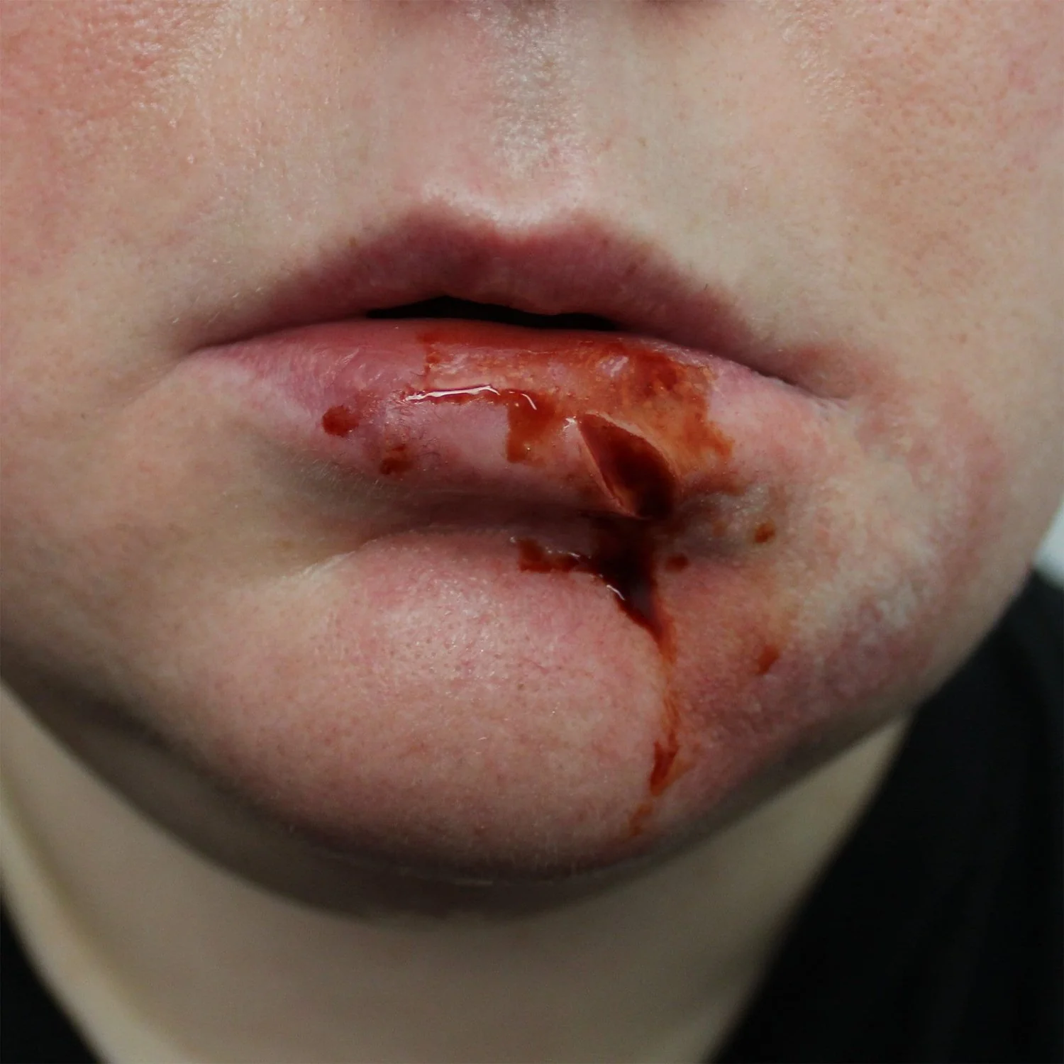 Jess FX Appliances -Swollen Split Lip - Image 2